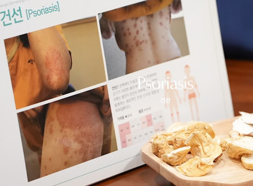 생기한의원 건선 관련 피부질환 감별 포인트 정리